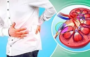 جلوگیری از تشکیل مجدد سنگ کلیه در فصل تابستان