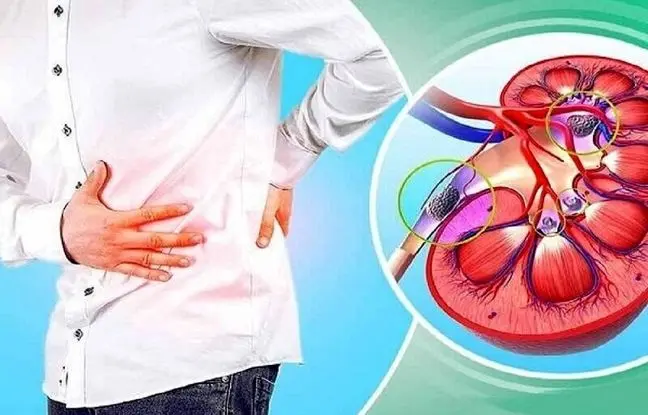 جلوگیری از تشکیل مجدد سنگ کلیه در فصل تابستان