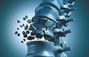استخوان این گروه از زنان بیشتر از بقیه پوک می‌شود + ویدئو