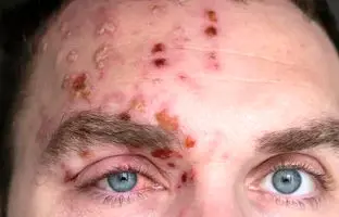 آبله‌مرغان در بزرگسالان چقدر خطرناک است؟ + ویدئو