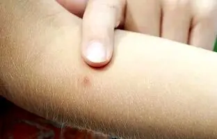 چرا جای نیش پشه می‌خارد؟