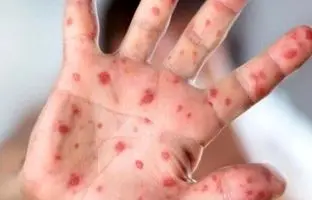 شیوع بیماری واگیردار در کشور؛ اگر واکسن نزنید تا ۹۰ درصد منتقل می‌شود