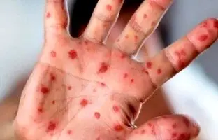 شیوع بیماری واگیردار در کشور؛ اگر واکسن نزنید تا ۹۰ درصد منتقل می‌شود