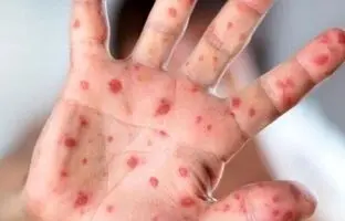 شیوع بیماری واگیردار در کشور؛ اگر واکسن نزنید تا ۹۰ درصد منتقل می‌شود