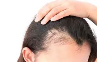 دلایل ریزش موی جلوی سر در زنان
