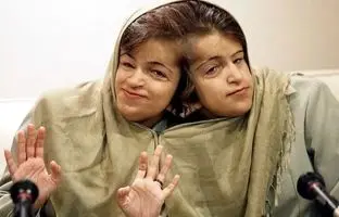  ‌یادی از دوقلوهای به‌هم چسبیده لاله و لادن + تصویر
