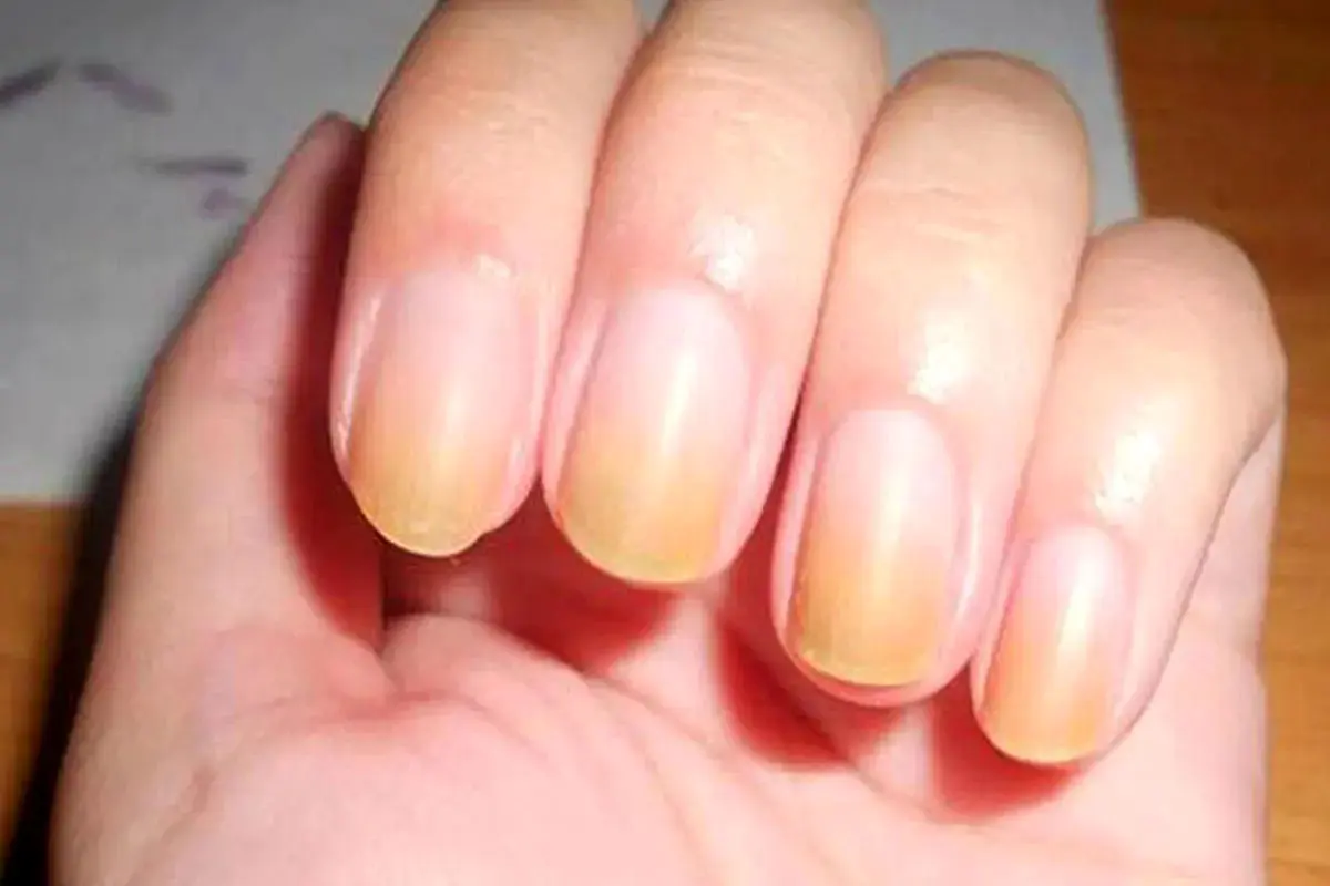 تغییر رنگ ناخن به قهوه ای یا زرد نشانه چیست؟ 
