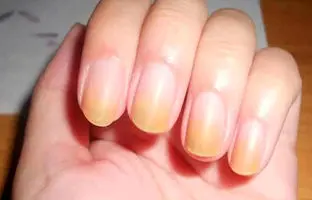 تغییر رنگ ناخن به قهوه ای یا زرد نشانه چیست؟ 