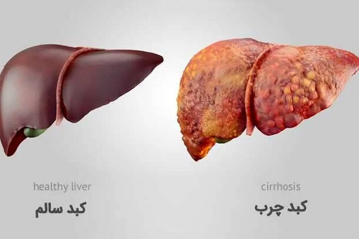 کبد چرب چه علائمی دارد و چگونه درمان می شود؟