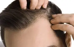 چرا شوره سر ایجاد می‌شود؟/ راه درمان