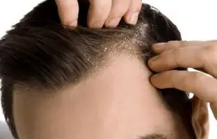 چرا شوره سر ایجاد می‌شود؟/ راه درمان