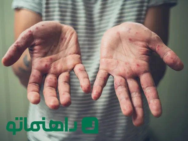 همه چیز درباره بیماری زونا