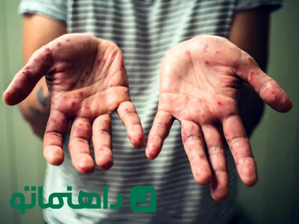 همه چیز درباره بیماری زونا