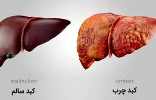 خوراکی‌های مفید و مضر برای کبد را بشناسید