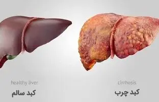 خوراکی‌های مفید و مضر برای کبد را بشناسید