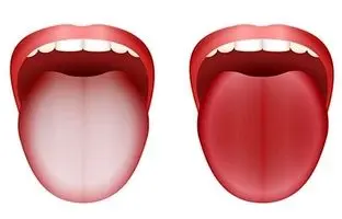 زبان سفید چه چیزی درباره سلامت می‌گوید؟