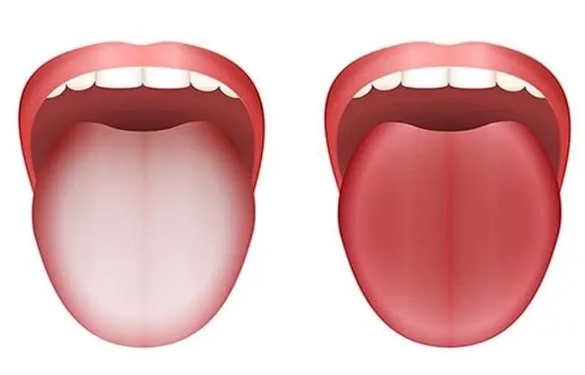 زبان سفید چه چیزی درباره سلامت می‌گوید؟