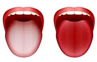 زبان سفید چه چیزی درباره سلامت می‌گوید؟
