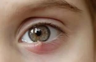 روشی برای از بین بردن گل مژه با استفاده از عسل + ویدئو