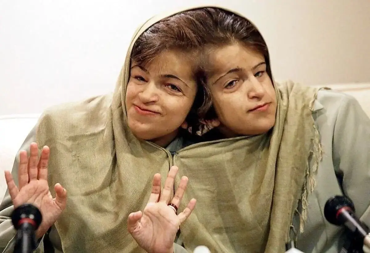  قصه زندگی لاله و لادن; خواهرانی با دو مغز و یک قلب+ عکس مزار 